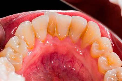 Periodoncia