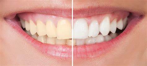 blanqueamiento dental