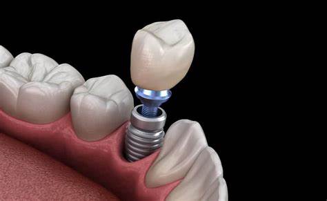 implantologia dental