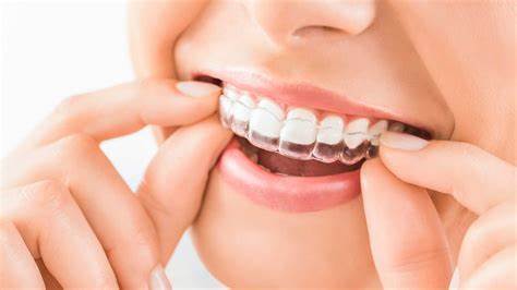 ortodoncia invisible invisalign en esparraguera