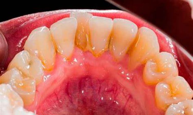 Periodoncia
