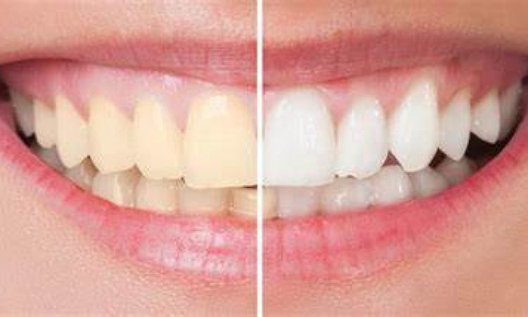 blanqueamiento dental