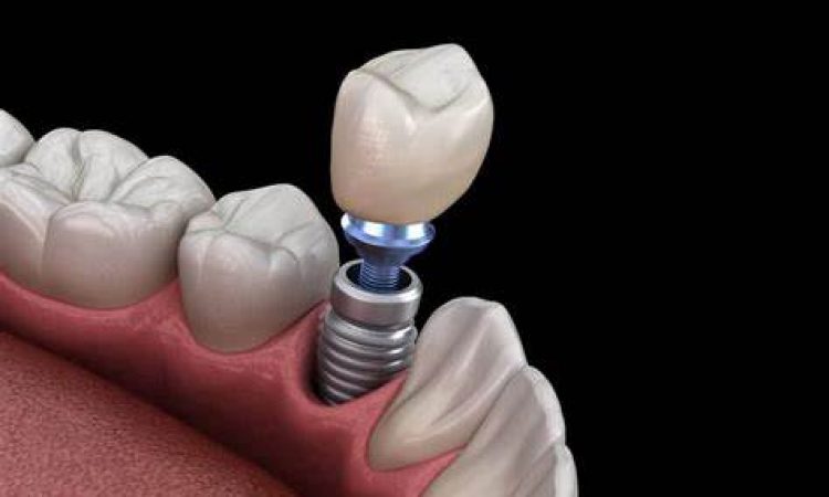 implantologia dental